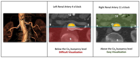 Co2 Injector CO2 Angiography in the Standard and Complex Endovascular Repair of the ...