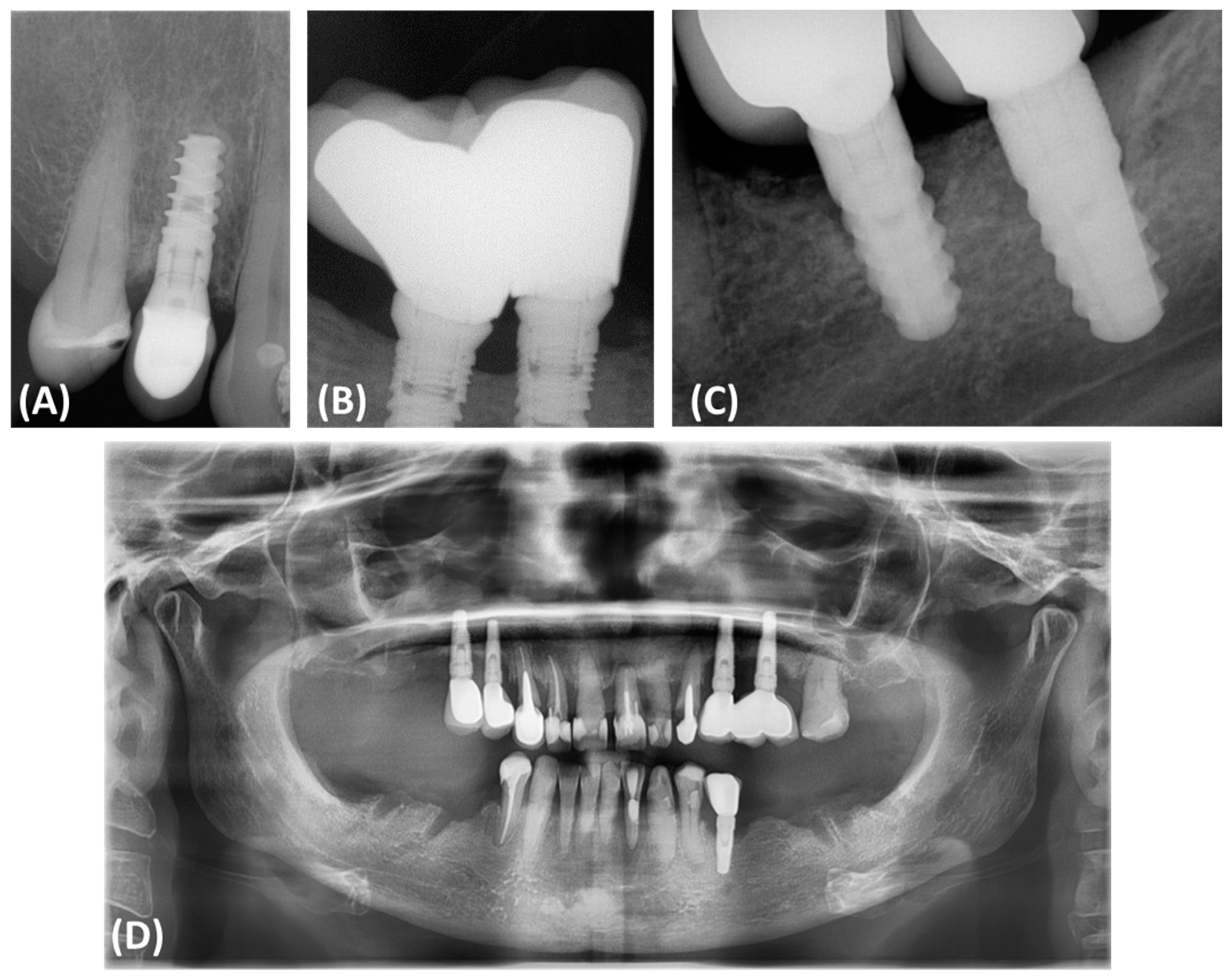 Evaluation of Peri-Implantitis Bone Defect Healing