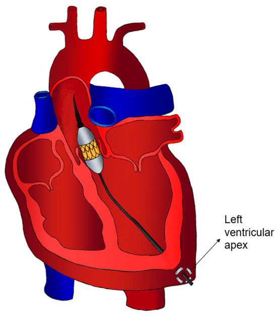 Exploring Optimal Strategies for Surgical Access in Transcatheter 