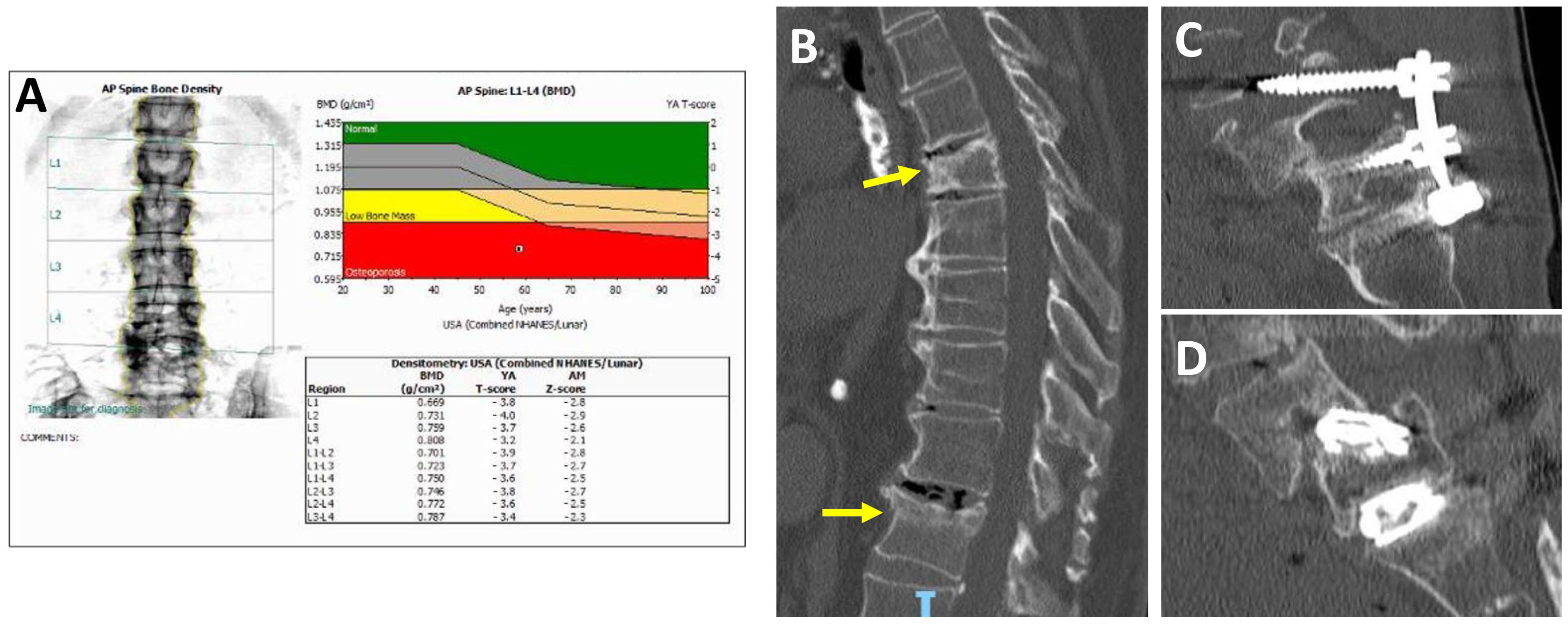 Bone Health Optimization in Adult Spinal Deformity Patients