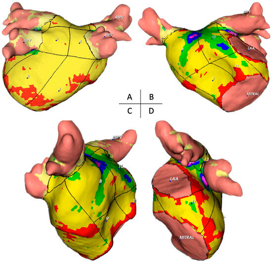 Left Atrial Wall Thickness Estimated by Cardiac CT: Implications for ...