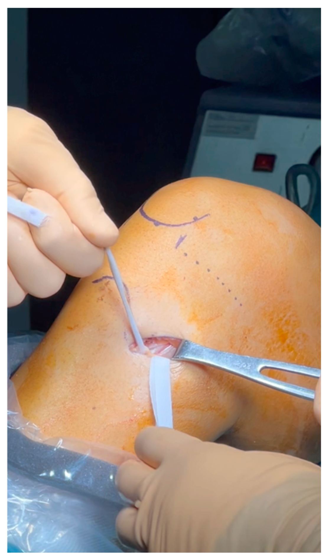 Anterior Cruciate Ligament Reconstruction Utilizing Double 
