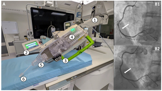 Features and Limitations of Robotically Assisted Percutaneous Coronary ...