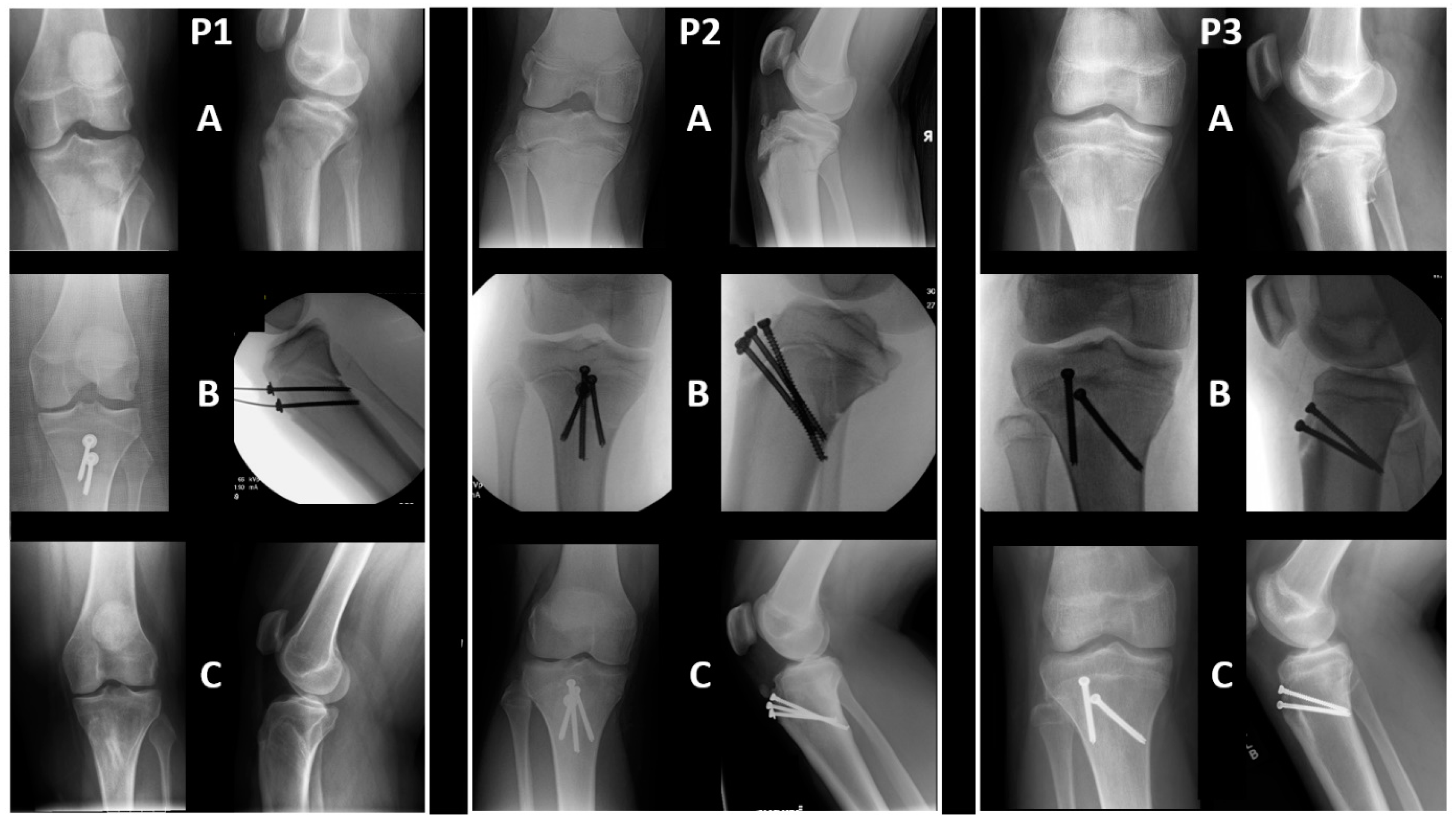 【コーウィン様用】NERVE / Fracture Loss of Fixation of a Type IV Supracondylar Humerus Fracture