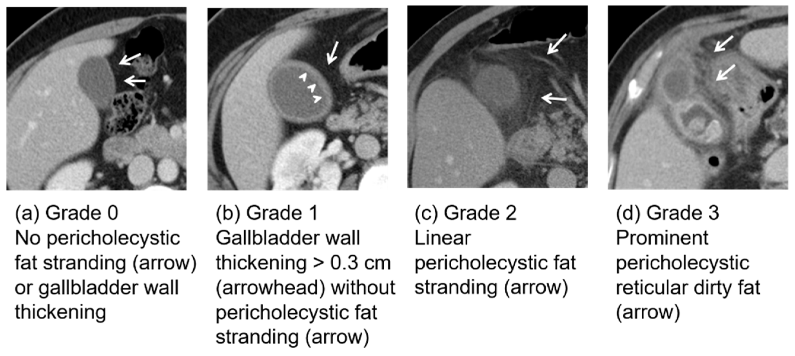 Pericholecystic Fat Stranding as a Predictive Factor of Length of 