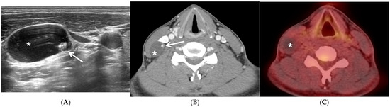Comparative Analysis of Metastatic Thyroid Carcinoma versus