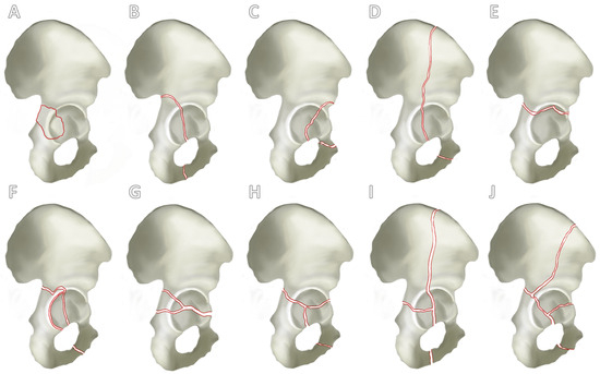 Treatment of Geriatric Acetabular Fractures Using the Modified