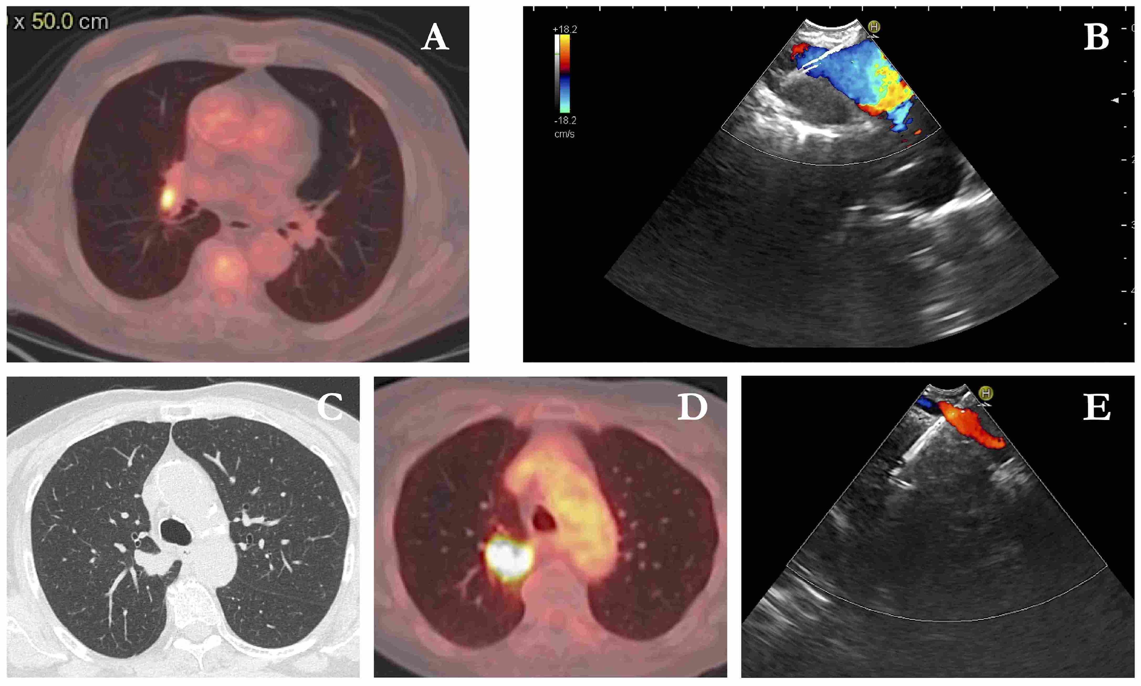 Abstracts of the Italian Society of Thoracic Endoscopy (SIET) 2024 