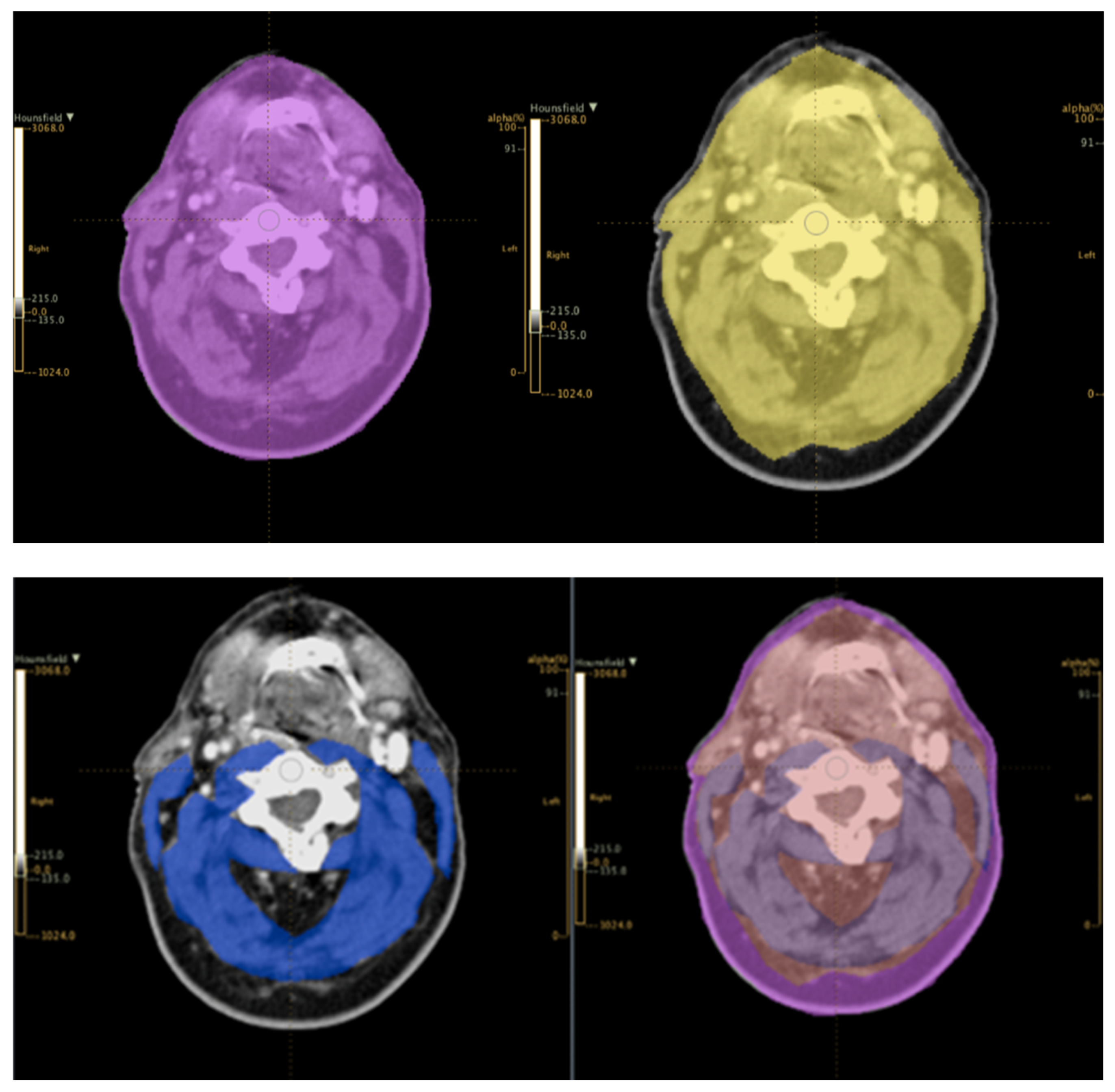 Head and Neck Cancer (HNC) Prehabilitation: Advantages and