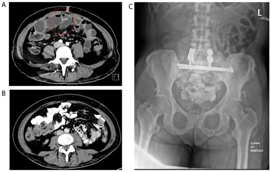 Anti-Hyperglycemic Medication Management in the Perioperative Setting: A Review and Illustrative Case of an Adverse Effect of GLP-1 Receptor Agonist Anti-Hyperglycemic Medication Management in the Perioperative Setting: A Review and Illustrative Case of an Adverse Effect of GLP-1 Receptor Agonist