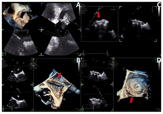 Initial Experience with the 4D Mini-TEE Probe in the Adult Population