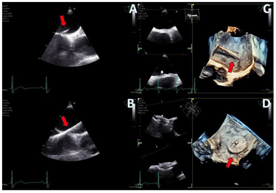 Initial Experience with the 4D Mini-TEE Probe in the Adult Population