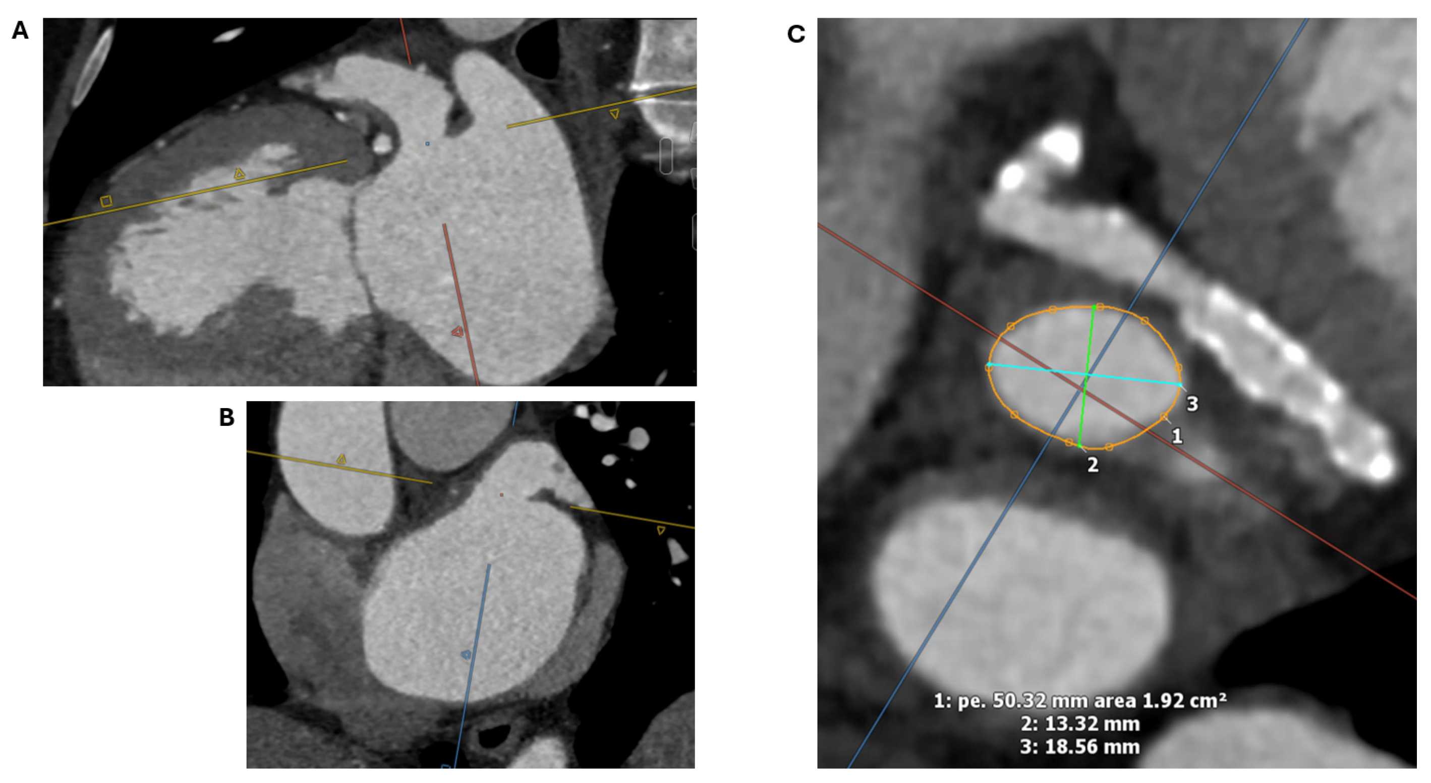 Advancements in 3D Transoesophageal Echocardiography (TOE