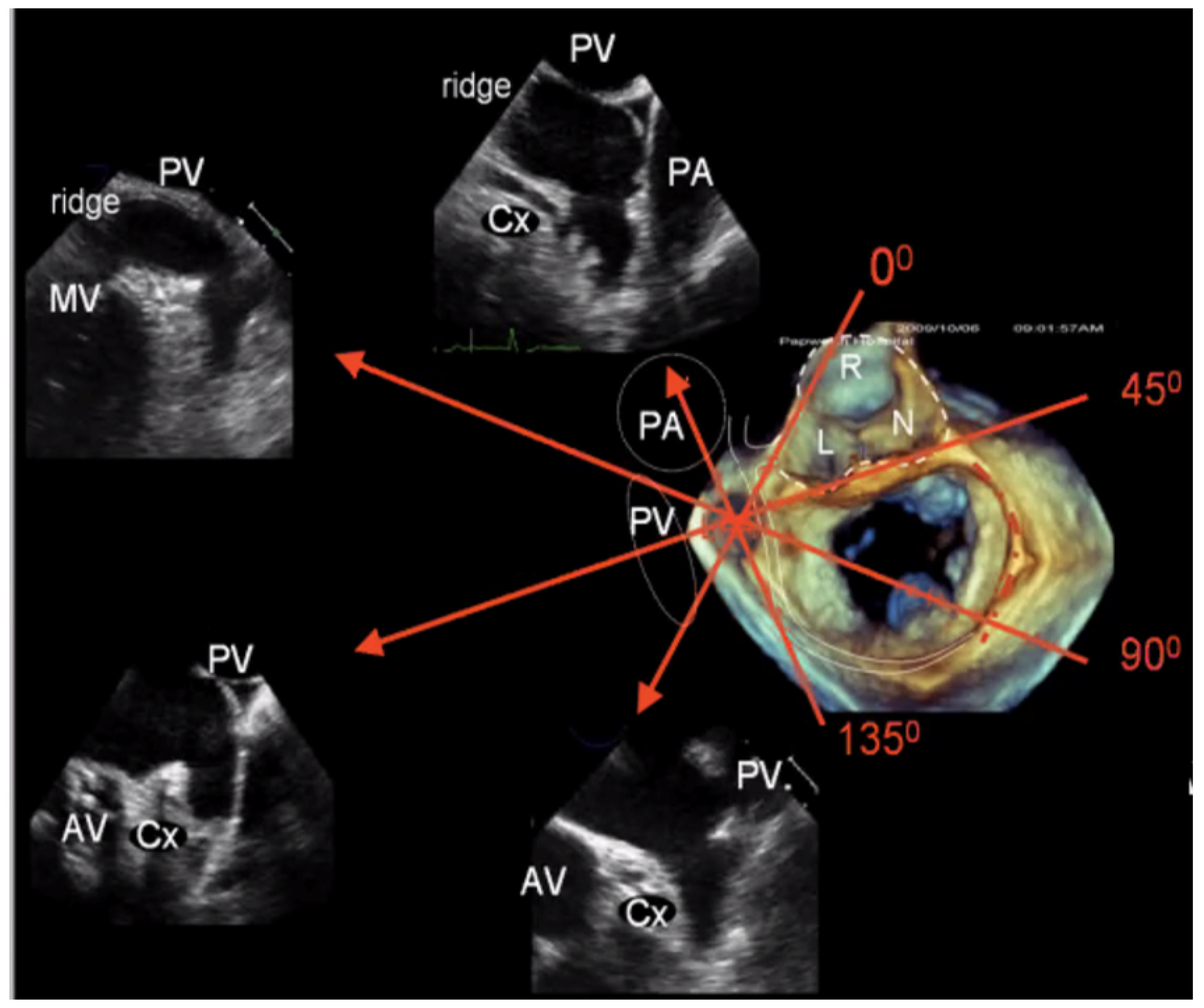 Advancements in 3D Transoesophageal Echocardiography (TOE