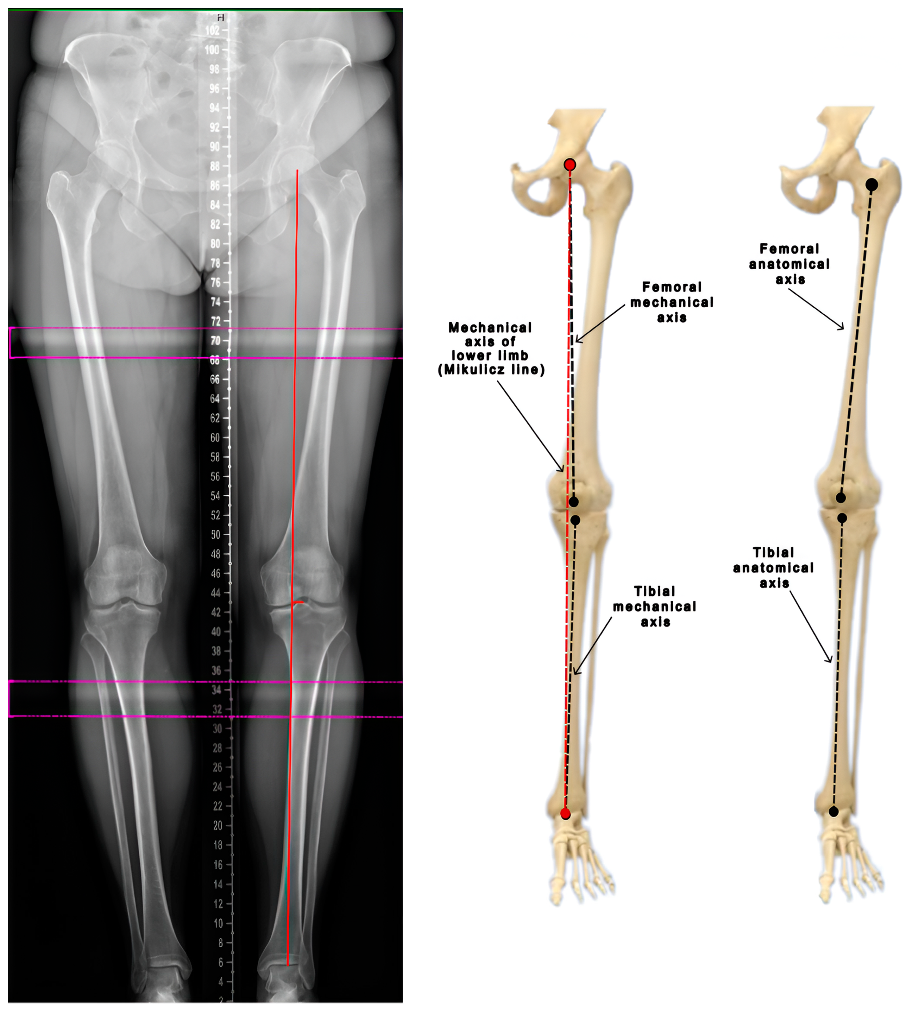 健康・医学 Occlusion Radiological Approach to Assessment of Lower-Limb Alignment