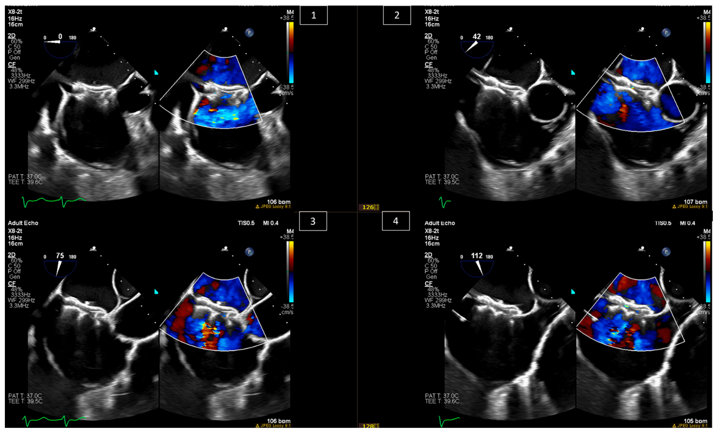 Highlights of Transesophageal Echocardiography During
