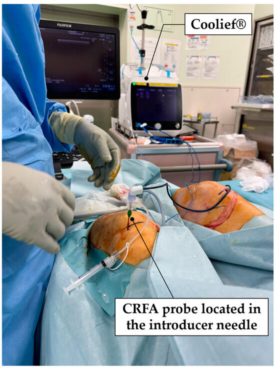 Short-Term Effects of Cooled Radiofrequency Ablation on Walking Ability ...