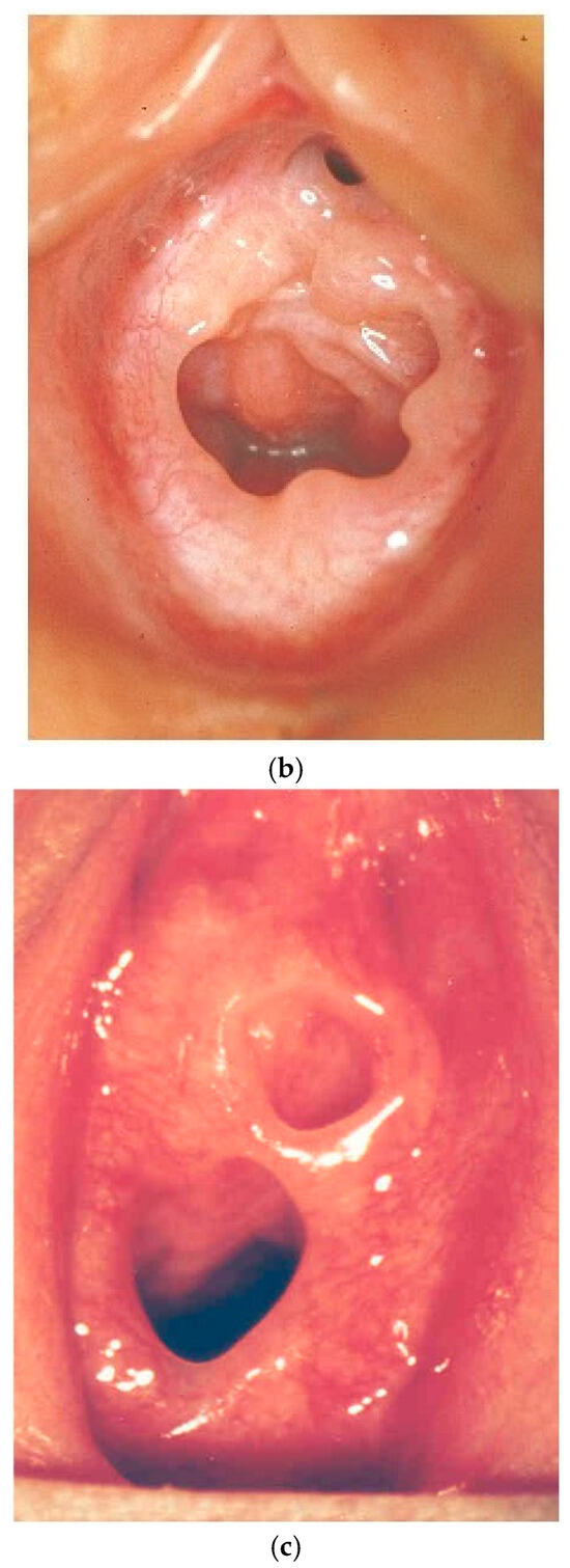 pediatric genital trauma An intricate vagina penetrating injury with a 22 cm cassava stick in situ  for 6 months: a case report | Journal of Medical Case Reports | Full Text