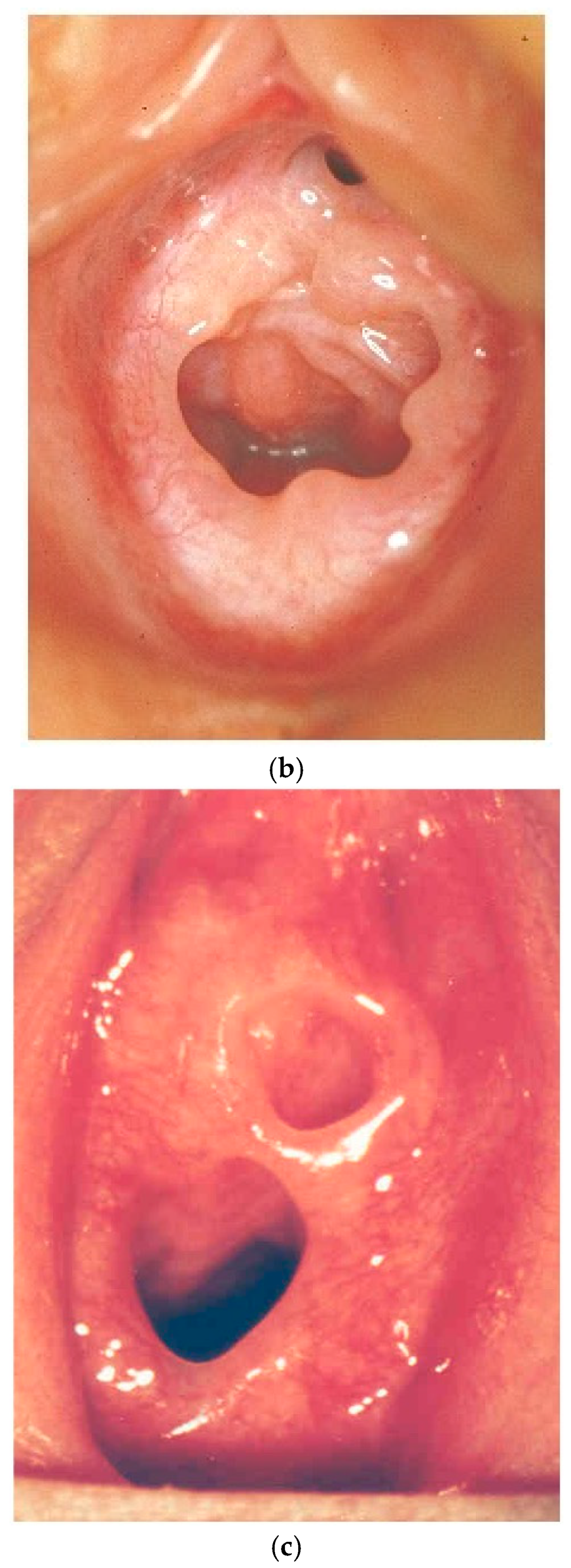 child hymen  Hematometrocolpos in a Teenager | New England Journal of Medicine