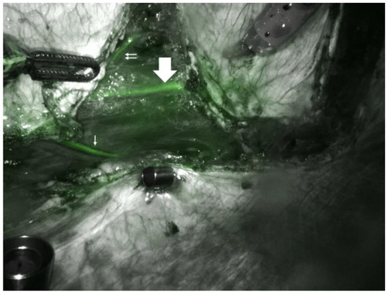 Robotic Rectus Abdominis Myoperitoneal Flap for Posterior Vaginal Wall Reconstruction: Experience at a Single Institution Robotic Rectus Abdominis Myoperitoneal Flap for Posterior Vaginal Wall Reconstruction: Experience at a Single Institution