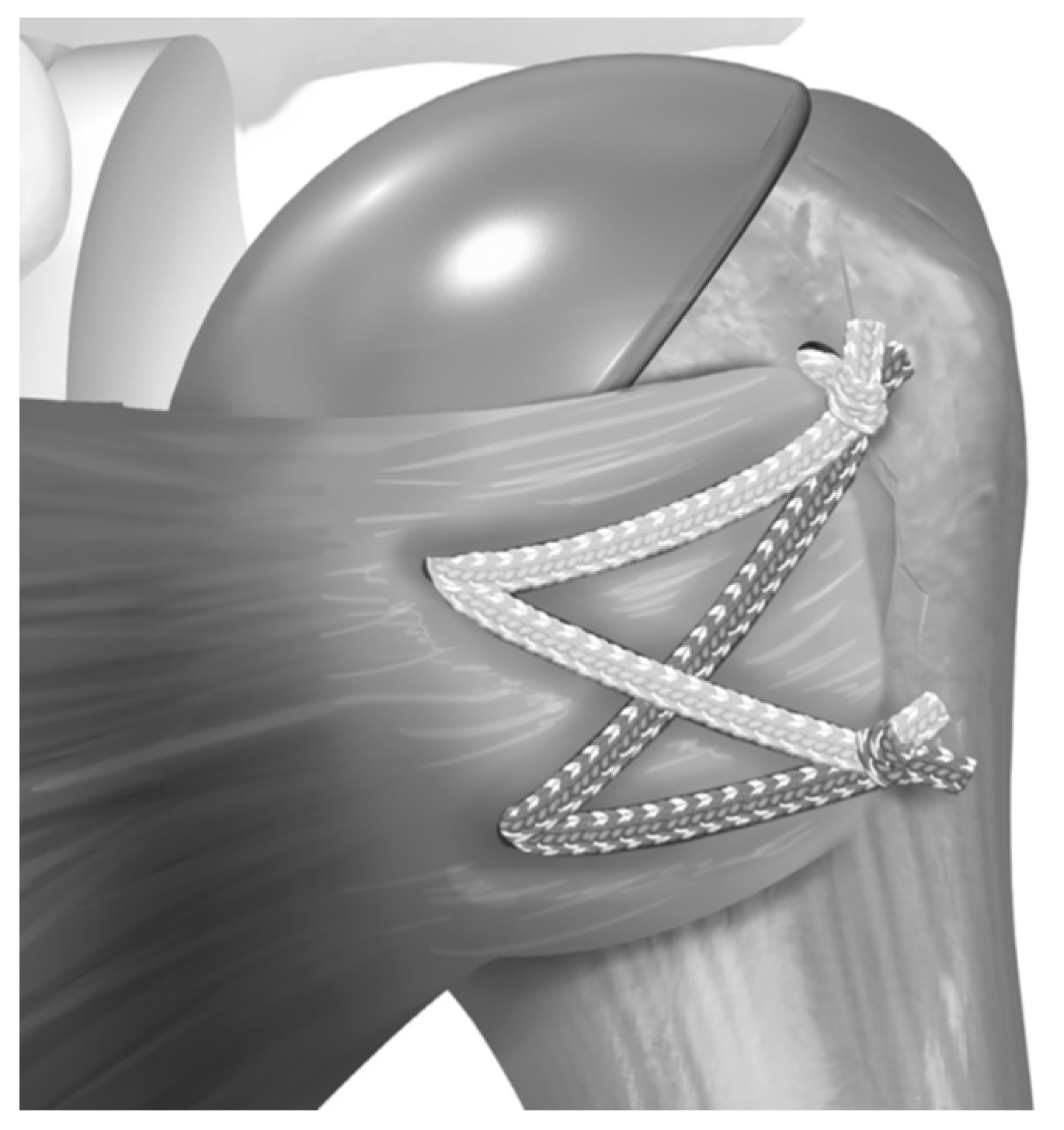 Comparing Repaired Subscapularis Tendon Integrity Using