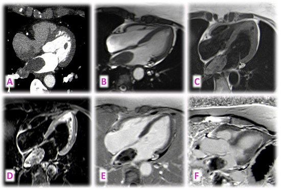 Is Math Included In Cardiovascular Radiology Diagnostic Algorithm Using Multimodal Imaging for the Differential ...