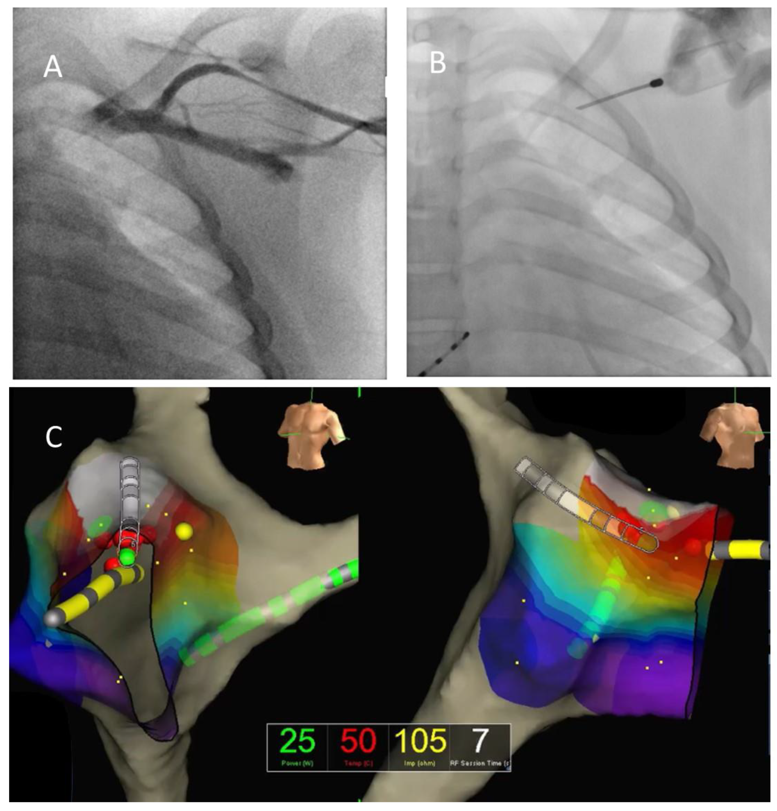 The Trans-Axillary Vein Approach for the Ablation of Anterior–Septal,  Anterior, and Anterior–Lateral Accessory Pathways in Children: More  than an Alternative to the Femoral Vein