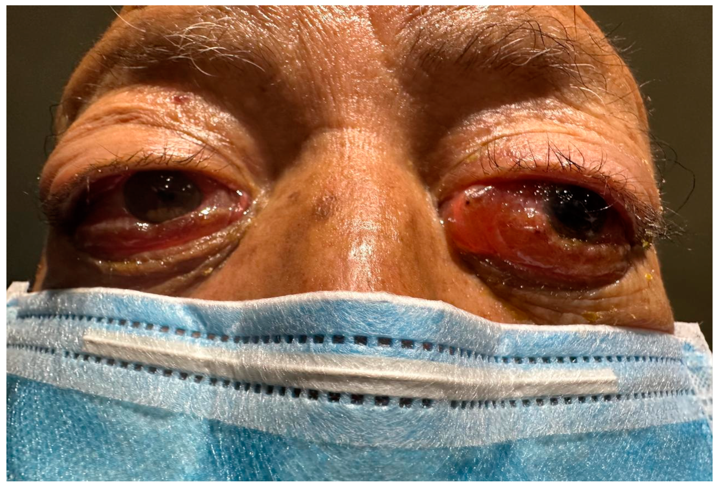 IgG4-RD-Associated Mikulicz Syndrome Without Classic