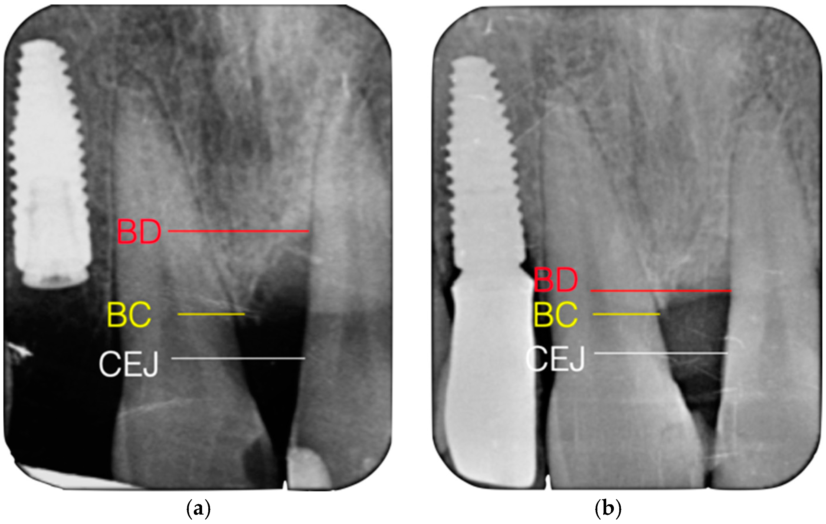 A Comparison of the Treatment of Periodontal Infraosseous