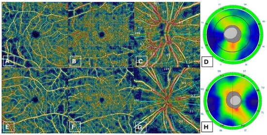 Radial Peripapillary Capillary Vessel Density as a New Biomarker in ...