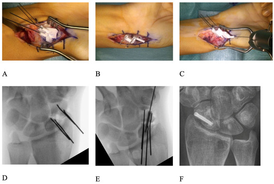 Three-Dimensional-Planned Patient-Specific Guides for