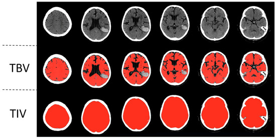 Brain Atrophy Is Associated with Hematoma Expansion in
