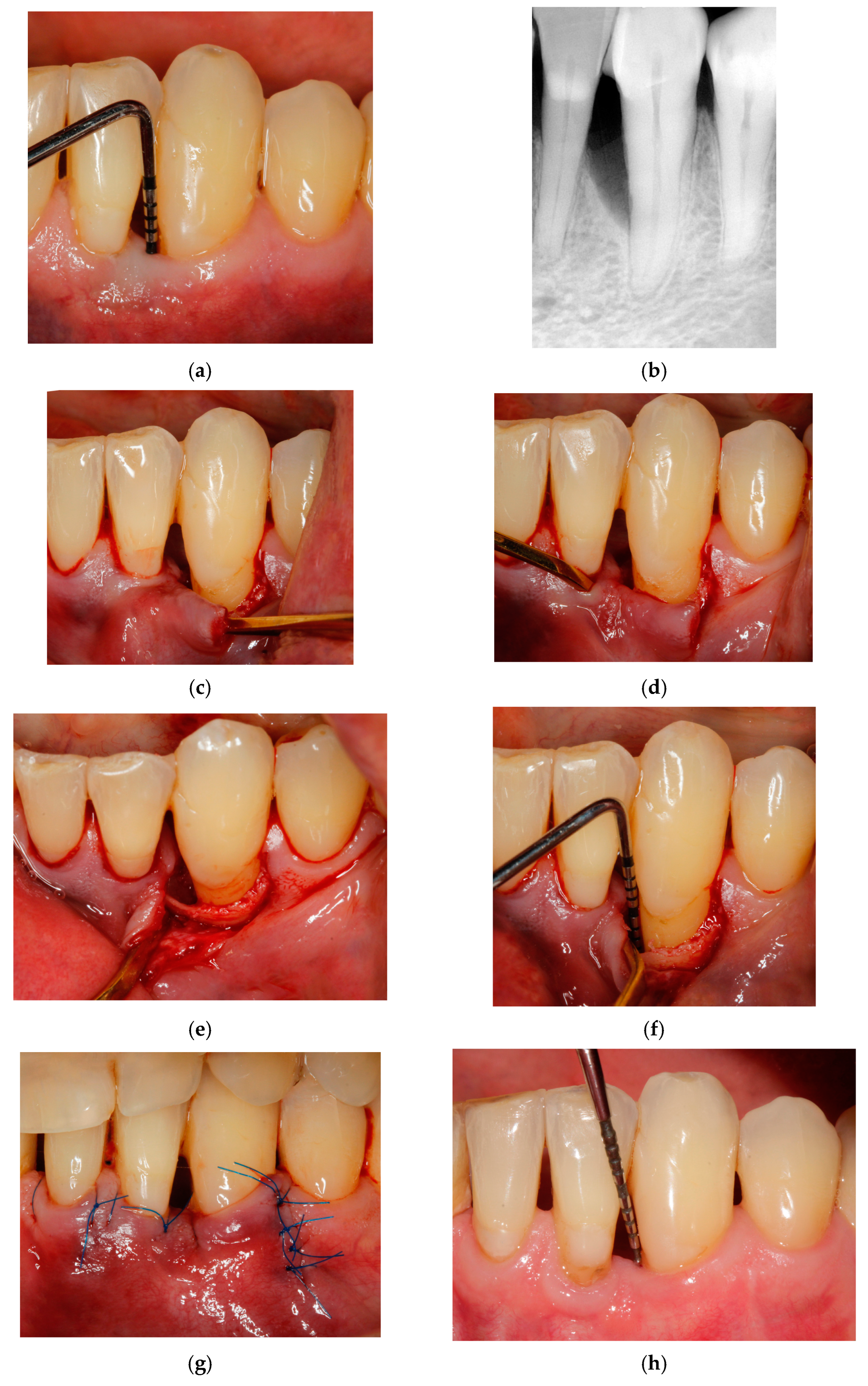 ロピア 爆買い Entire Papilla Matrix Enamel with Technique Preservation 健康・医学