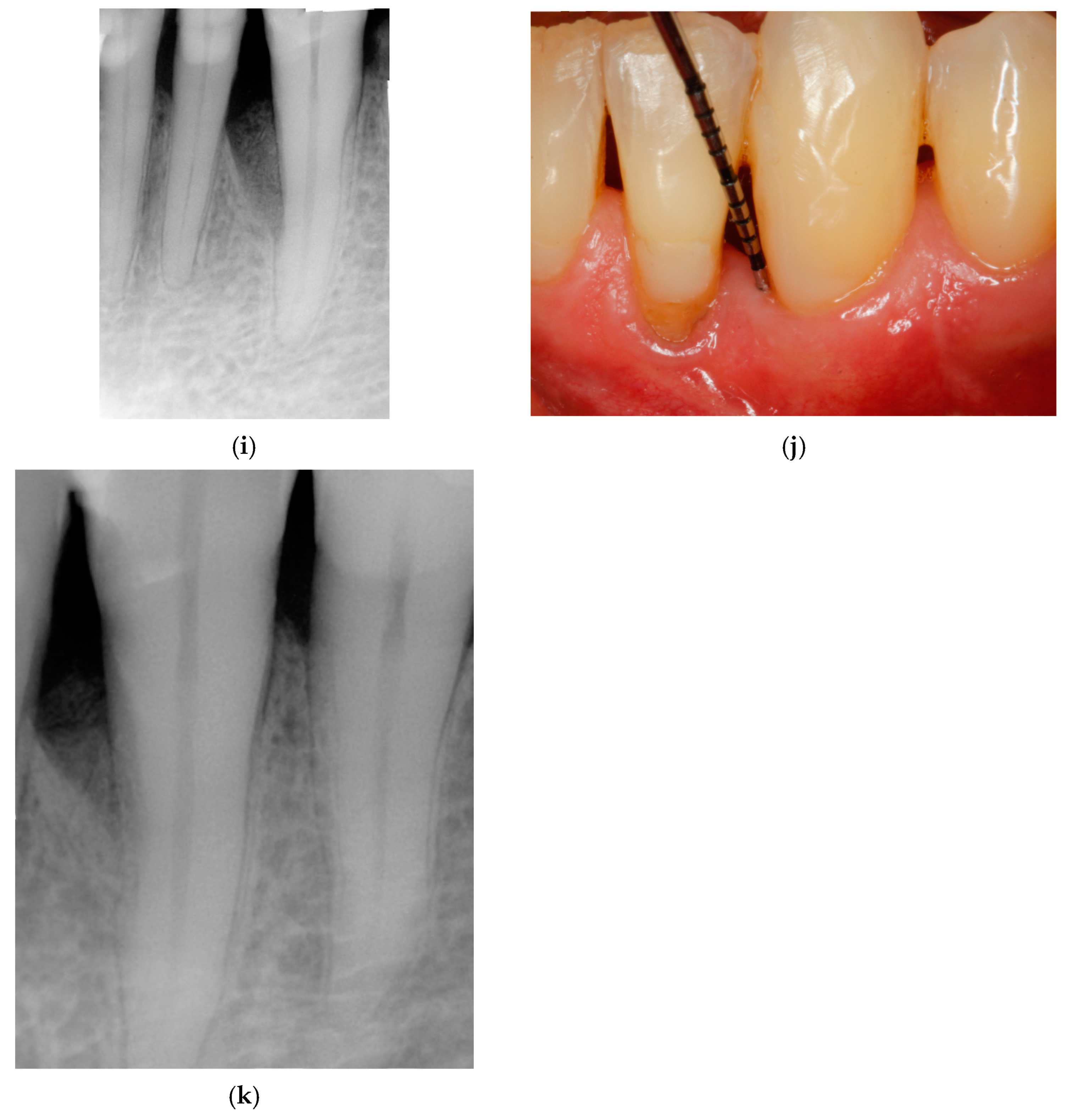Entire Papilla Preservation Technique with Enamel Matrix