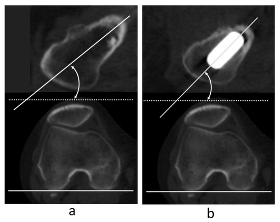 大腿骨近位部骨折 Osteosynthesis & Arthroplasty 脛骨用圧迫プレート - A.L.P.S.® - Zimmer Biomet - 近位部