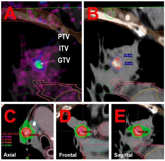 On the Use of 4D-PET/CT for the Safe SBRT Re-Irradiation of Central ...