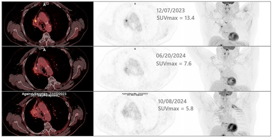 On the Use of 4D-PET/CT for the Safe SBRT Re-Irradiation of Central ...