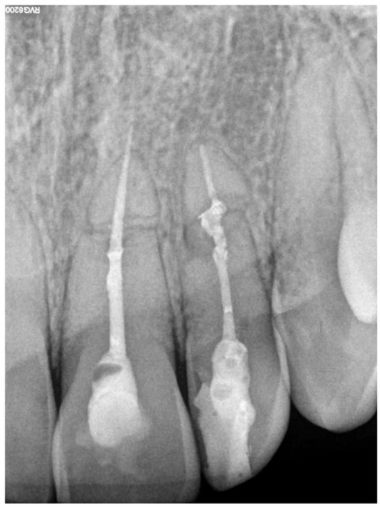 【裁断済み】How to Endodontics The State of th 裁断済み】How to Endodontics The State of th 裁断済み】How