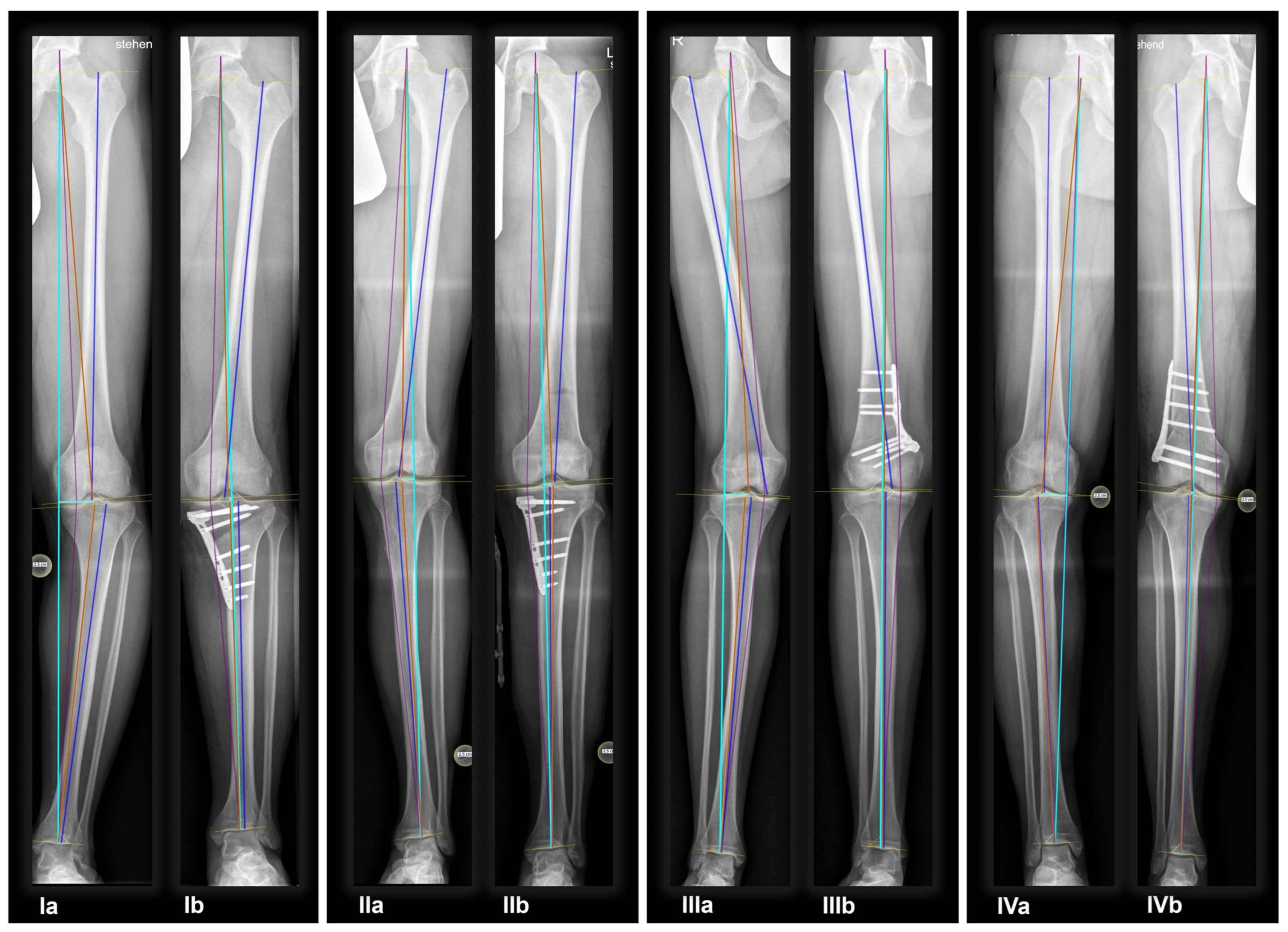 Changes of Knee Phenotypes Following Osteotomy Around the