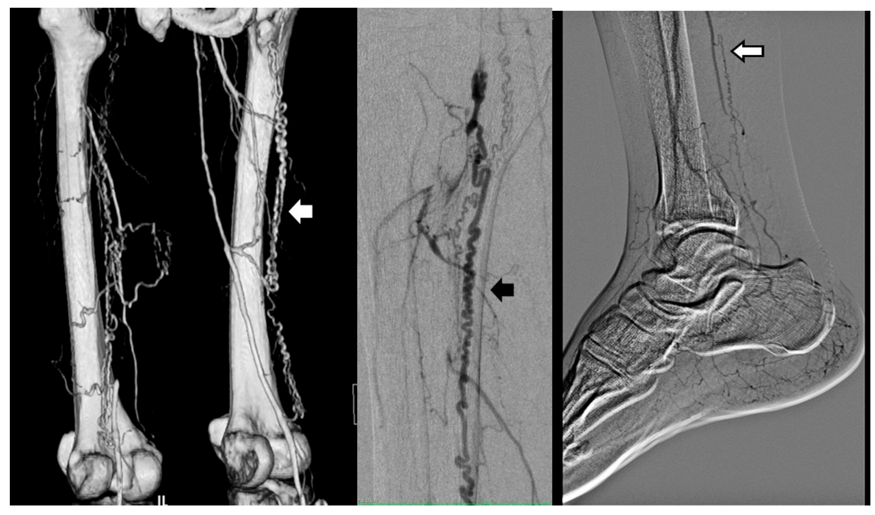 The Angiography Pattern of Buerger’s Disease: Challenges and ...