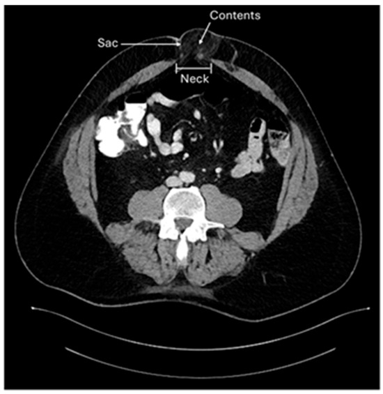 Elective Umbilical Hernia Repair in Adults in the 21st Century: Challenging the Status Quo