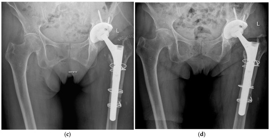 Septic Two-Stage Cementless Hip Revision Arthroplasty Is Safe but