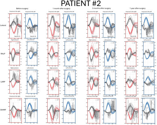 Normal Vhit Application of Video Head Impulse Test in the Diagnosis and Follow-Up ...