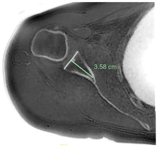 ZTE MRI for Rotator Cuff Tear Arthropathy: Integrated Bone–Muscle