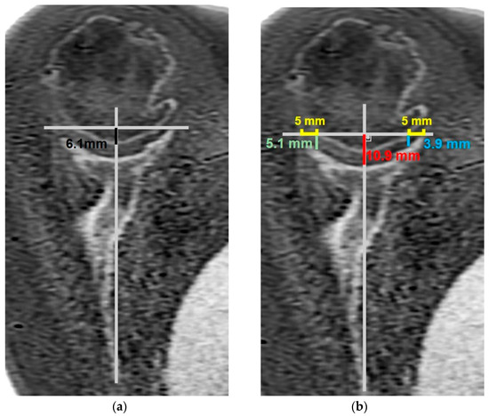 ZTE MRI for Rotator Cuff Tear Arthropathy: Integrated Bone–Muscle