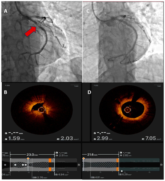 Acute Coronary Syndromes: State-of-the-Art Diagnosis, Management, and ...