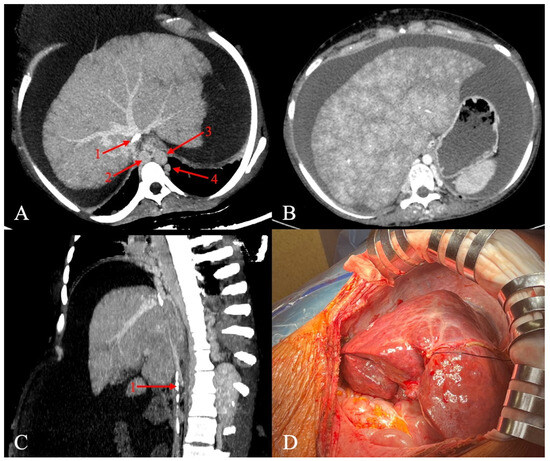 Inferior Vena Cava-Atrial Anastomosis in Liver Transplant