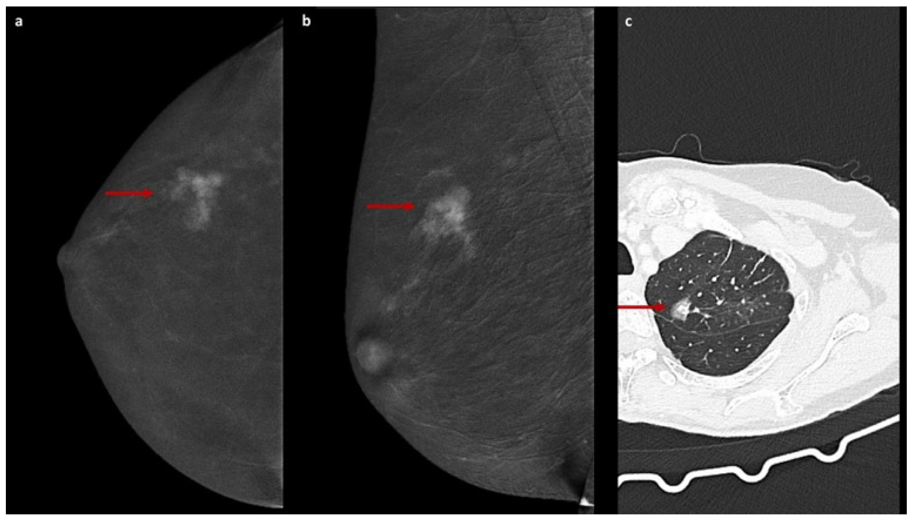 ground-glass-enhancement-on-contrast-enhanced-mammography-a-ct