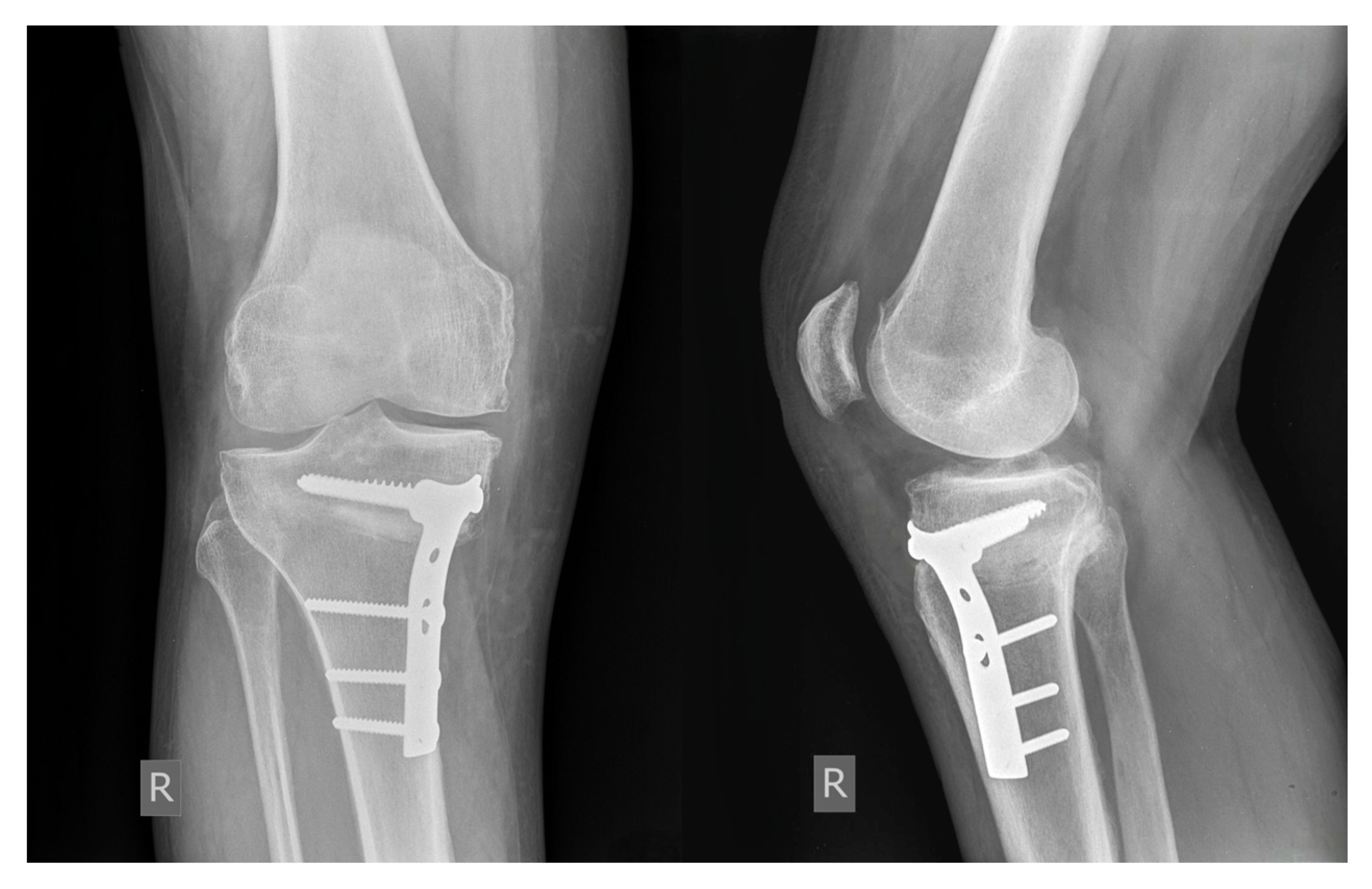 The Magnitude of Varus Correction and Its Influence on