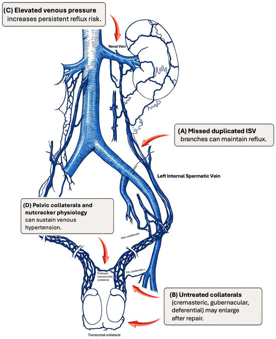 Why Varicoceles Recur: Missed Venous Anatomy and Contemporary Strategies  for Salvage